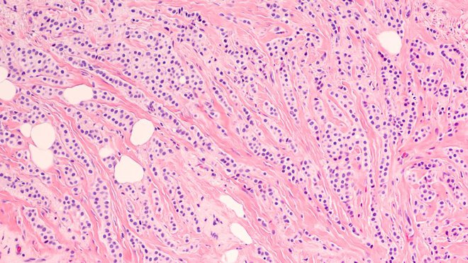 Histološki vzorec tkiva dojke. Celice invazivnega lobularnega karcinoma so običajno vidne šele pod mikroskopom. Foto: Shutterstock